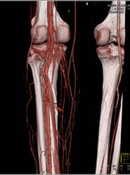 Runoff With Increased Flow - CTisus CT Scan