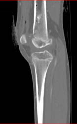 Femur Fracture S/P Trauma - CTisus CT Scan