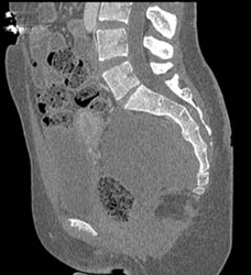 Presacral Neurogenic Tumors - CTisus CT Scan