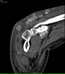 Gout - CTisus CT Scan