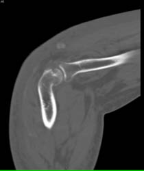 Gout - CTisus CT Scan