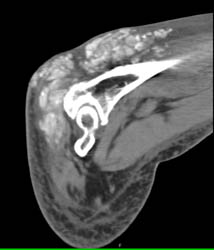 Gout - CTisus CT Scan