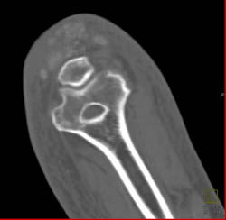 Gout - CTisus CT Scan