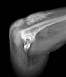 Gout - CTisus CT Scan