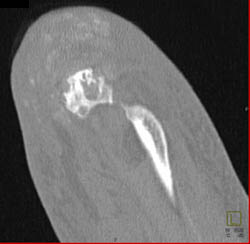 Gout - CTisus CT Scan