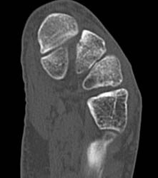 Base of Metatarsal Fracture With Lifranc Injury - CTisus CT Scan