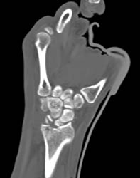 Distal Radial Fracture and Scaphoid Fracture - CTisus CT Scan