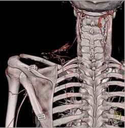 Collaterals Shown in MPR - CTisus CT Scan