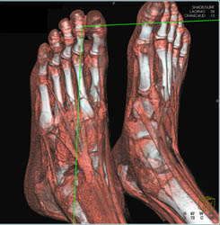 Tendons- Normal - CTisus CT Scan