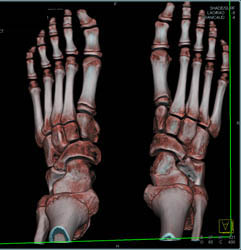 Fibrous Coalition on Left - CTisus CT Scan