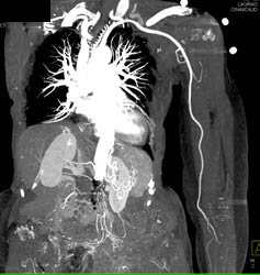 Patent Left Subclavian and Brachial Artery With Bone Removal - CTisus CT Scan