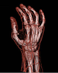 Cellulitis - CTisus CT Scan