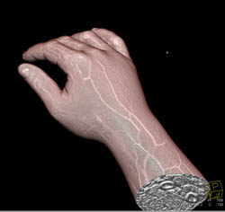 Cellulitis - CTisus CT Scan