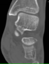 Cellulitis - CTisus CT Scan