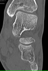 Subtle Fracture Calcaneus Best Seen on 3D - CTisus CT Scan