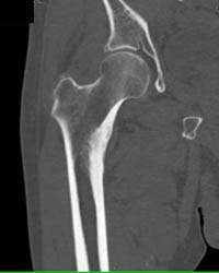 Osteoid Osteoma With Bone Remodelling - CTisus CT Scan