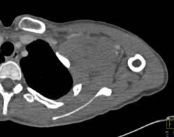 Sarcoma in Left Axilla - CTisus CT Scan