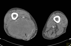 Sarcoma in Thigh With Necrosis - CTisus CT Scan