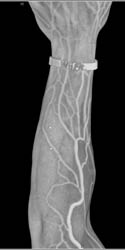 CTA Scan With Vascular Mapping - CTisus CT Scan