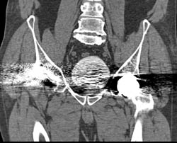 Failed Right Total Hip Replacement (THR) - CTisus CT Scan