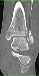 Trauma to Ankle With Fracture and Joint Fragments - CTisus CT Scan