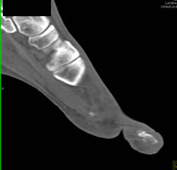 Osteomyelitis Great Toe - CTisus CT Scan