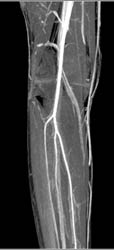 Ct Knee Without Vascular Injury - CTisus CT Scan