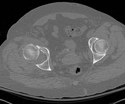 Dislocated Hip With Fracture - CTisus CT Scan