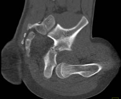 Dislocated Hip in Multiple Views - CTisus CT Scan