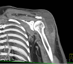 Abscess Involves Deltoid Muscle - CTisus CT Scan