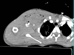 GSW to Axilla With Active Bleed and Hematoma. Nice CTA - CTisus CT Scan