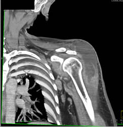 Deltoid Abscess - CTisus CT Scan