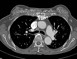 Calcifications in Breast Due to Worm- Cysticercosis - CTisus CT Scan