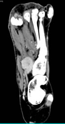 Angiosarcoma - CTisus CT Scan