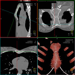 Pectus - CTisus CT Scan