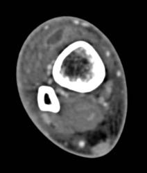 Abscess and Cellulitis - CTisus CT Scan