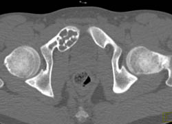 Bone Cyst Vs Fibrous Dysplasia - CTisus CT Scan