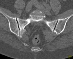 Sclerotic Bone Metastases - CTisus CT Scan