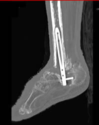 Nonunion S/P Fusion Attempt - CTisus CT Scan