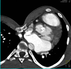 Pectus Deformity - CTisus CT Scan