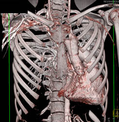 Pectus Deformity - CTisus CT Scan