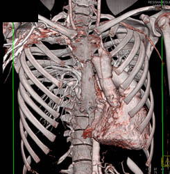 Pectus Deformity - CTisus CT Scan