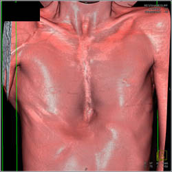 Pectus Deformity - CTisus CT Scan