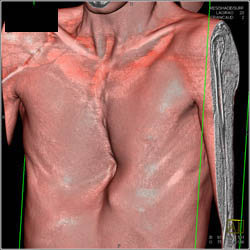 Pectus Deformity - CTisus CT Scan