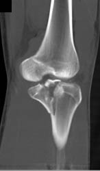 Tibial Plateau Fracture - CTisus CT Scan