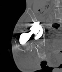 Failed Total Hip Replacement (THR) With Cup Slippage - CTisus CT Scan