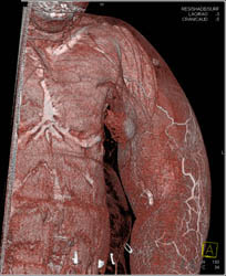 CTA Shoulder With Arteriovenous (AV) Fistulae - CTisus CT Scan