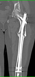 Non Union Femur Fracture - CTisus CT Scan