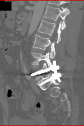 Pins in Spine S/P Fusion With Pins Near Iliac Artery - CTisus CT Scan