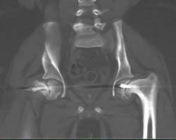 Pinning for Slipped Capital Femoral Epiphysis (SCFE) - CTisus CT Scan